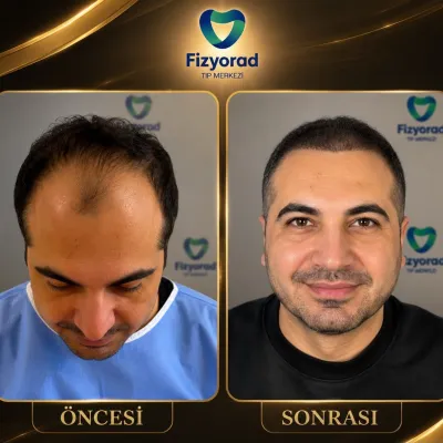 Saç Ekimi & Saç Sağlığı